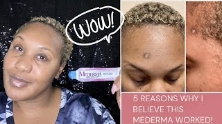 5 REASONS WHY I BELIEVE MEDERMA WORKED SCAR UPDATE MEDERMA RESULTS BEFORE amp AFTER NIJAH J [upl. by Dnar]