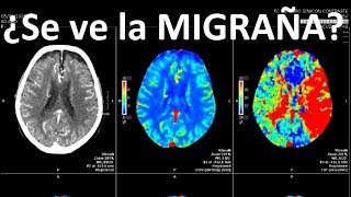 Se puede ver DOLOR de CABEZA o MIGRAÑA en resonancia o TAC [upl. by Losiram]