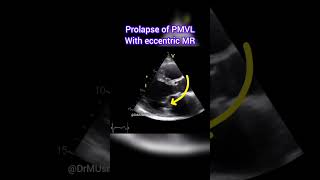 Prolapse of Posterior Mitral Valve Leaflet with Eccentric MR echocardiogram echocardiography [upl. by Humble441]