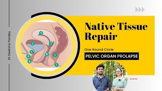 Native Tissue Repair  Pelvic organ prolapse  NTR [upl. by Nonnac]