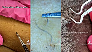 Removing Ingrown Hair Compilation part 2 [upl. by Syned]