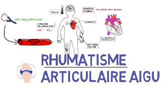 Rhumatisme articulaire aigu RAAde A à Z [upl. by Eniamert]