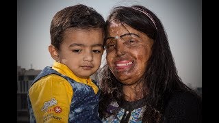 Acid Attack Survivor Finds Love [upl. by Neenwahs]