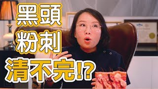 黑頭粉刺清都清不完，我該如何有效清粉刺？粉刺我到底該不該清？ [upl. by Rubi]