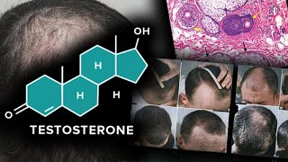 Testosterone Doesnt Grow Scalp Hair [upl. by Jovia]