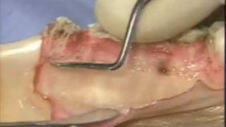 Introductory Periodontal Surgical Techniques The Apically Positioned Flap and Crown Lengthening [upl. by Mihsah]