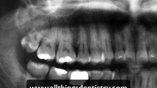 3rd Molar Extractions  Maxillary Molar Apices [upl. by Darryn]