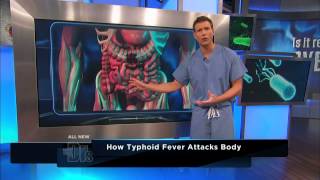 How Typhoid Fever Affects the Body  The Doctors [upl. by Ambrosane]