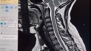 Mri cervical spine analysis with pathology in a simple way [upl. by Sherman301]