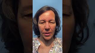 Patient with Meige syndrome facial spasms being treated with Botox [upl. by Abagael]