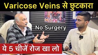 Varicose Veins Treatment in Ayurveda  How to Cure Varicose Veins Problem  The Health Show [upl. by Kannav]