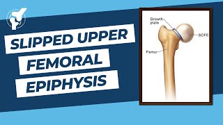 Slipped Capital Femoral Epiphysis  SUFE  SCFE   How to Prevent Avascular Necrosis [upl. by Yecaw]