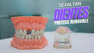 Como hacer protesis dental removible provisional con acrilico [upl. by Addia]