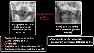 Interpretation TDM cérébrale  Radiographie du rachis cervical [upl. by Gaynor838]