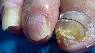 Onychomycosis infected the whole foot professional pedicure master【Pedicure Master Lin Jun】 [upl. by Uda]