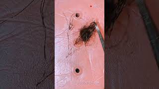 Removal of ingrown hair [upl. by Nicolais]