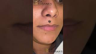 Mole Removal EXPERT Shares Top Secrets  DrLalit Kasanas [upl. by Narak]