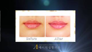 KOREA Mouth corner lift before amp after plastic surgery [upl. by Nitsir862]