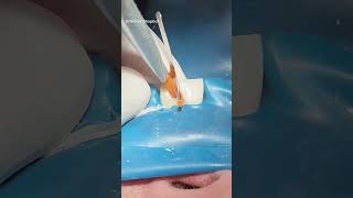 Root canal treatment amp composite restoration dentist [upl. by Fletch]