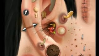 Itchy amp Smelly Ear Stone Removal Digging Out Super Big Earwax [upl. by Sido]