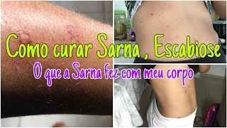 Como CURAR SARNA ESCABIOSE dicas e TRATAMENTO [upl. by Elaen]