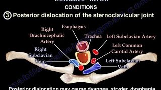 Sternoclavicular Joint Dislocation Review  Everything You Need To Know  Dr Nabil Ebraheim [upl. by Arama]