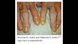 Osteoarthritis  Osteophytes on PIP Bouchards Nodes DIP Heberdens Nodes [upl. by Navy]