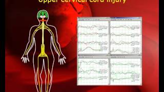 quotPatient Transparentquot Intraoperative Neurophysiological Monitoring in MISS [upl. by Eibur]