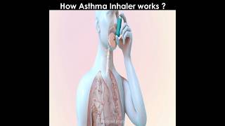 How asthma inhaler works [upl. by Eltsirc]