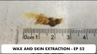 SKIN AND EAR WAX REMOVAL  EP 52 [upl. by Angy]