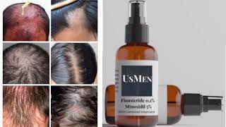 Usmen Hair Loss Treatment Topical Solution Finasteride Minoxidil [upl. by Demetris]