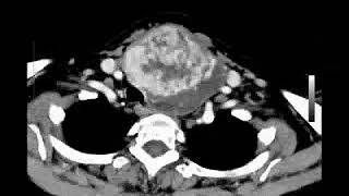 CAT Scan of a Very Large Goiter in the Left Thyroid [upl. by Rowena]