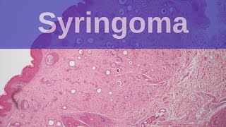 What is a Syringoma  Pathology mini tutorial [upl. by Ahders]