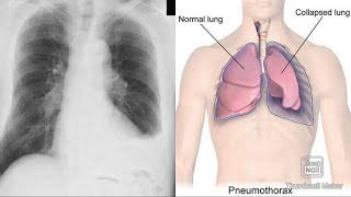 Pleurisy Pleural effusion Pneumothorax Hydropneumothorax Empyema Hemothorax clinicalAnatomy [upl. by Enrobialc]