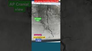 LAD Artery Angiography l echo angiography angioplasty shorts [upl. by Avron137]