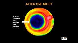 HOW DOES OVERNIGHT VISION CORRECTION WORK [upl. by Yral]