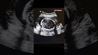 Fetal Biometry Series 1  Measuring the Biparietal Diameter pregnancy ultrasound [upl. by Caravette405]