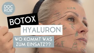 BOTOX oder HYALURON – wann verwendet man was Dr Rolf Bartsch [upl. by Ayo836]