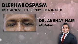 Understanding Blepharospasm Treatment  Botulinum Toxins Dr Akshay Nair Mumbai [upl. by Adnamma]