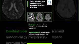 Cortical Tubers and Subependymal NodulesTuberous sclerosis [upl. by Nnylkcaj]