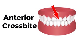 Easy Anterior Crossbite Correction for Pediatric Dentists in a Early Mixed Dentition Patient [upl. by Alenas341]