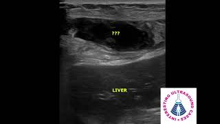 RECTUS SHEATH HEMATOMA ON ULTRASOUND  DUE TO VIOLENT COUGHING [upl. by Algernon]