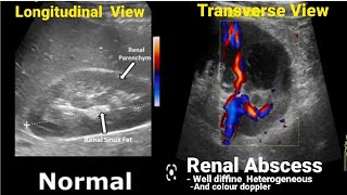 Kidney Ultrasound Normal vs Abnormal Appearances Comparison [upl. by Hearsh]