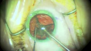 Routine Cataract Surgery  Narrated [upl. by Slin]