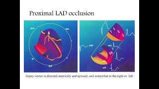 Localizing the culprit artery blockage in patients experiencing a STEMI ECG analysis  MI [upl. by Urita102]