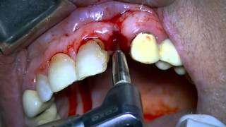 Implant placement using bone expansion technique [upl. by Elirpa]