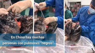 Negros e inservibles así recibió pulmones para donación un médico en China [upl. by Eivi]