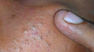 sac be spa blackheads elderly 2024  sac be spa old age blackheads acne  sac be spa face today 500 [upl. by Winnick]