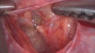 Uterine Artery Ligation Clipping  Anterior and Posterior Approach [upl. by Mohammad]