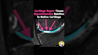 Fig 5C09 MRI Findings of Autologous Chondrocyte Implantation [upl. by Neeoma]